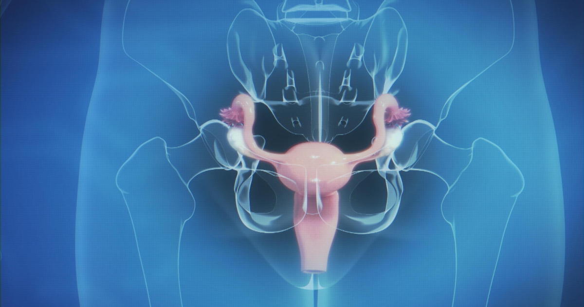 آندومتریوز / Endometriosis