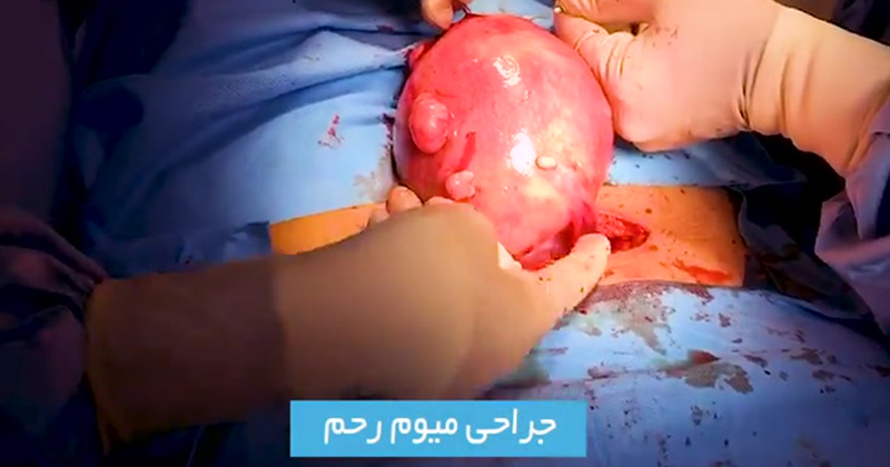 تصمیم برای جراحی میوم بستگی به عوامل مختلفی دارد؟