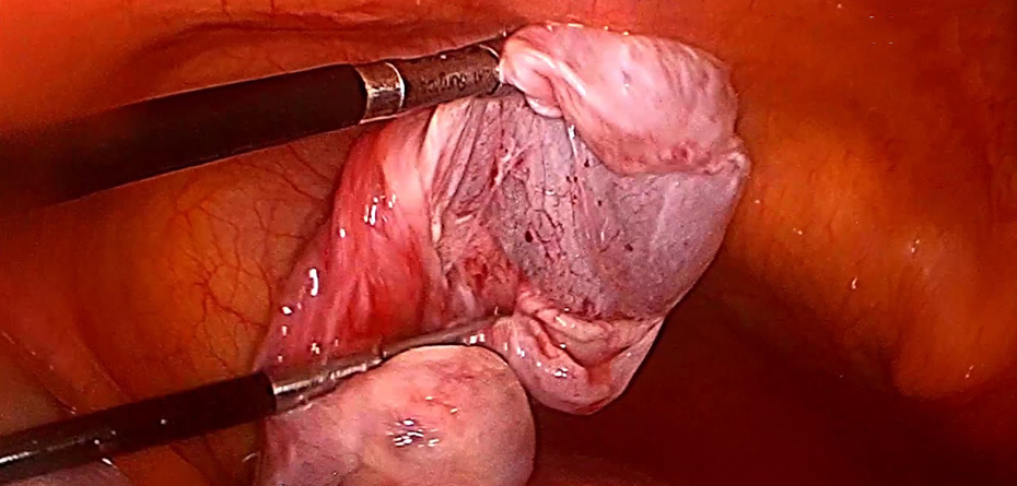 جراحی کیستها و توده های تخمدان