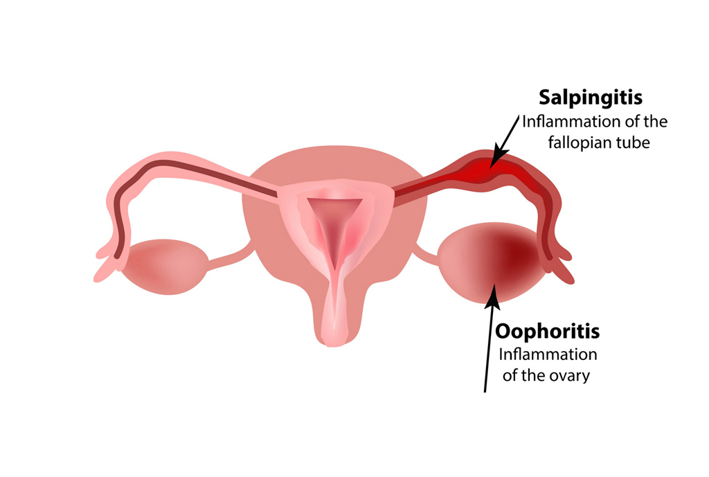سالپنژیت / Salpingitis