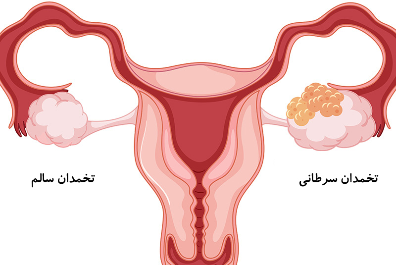 علائم سرطان تخمدان