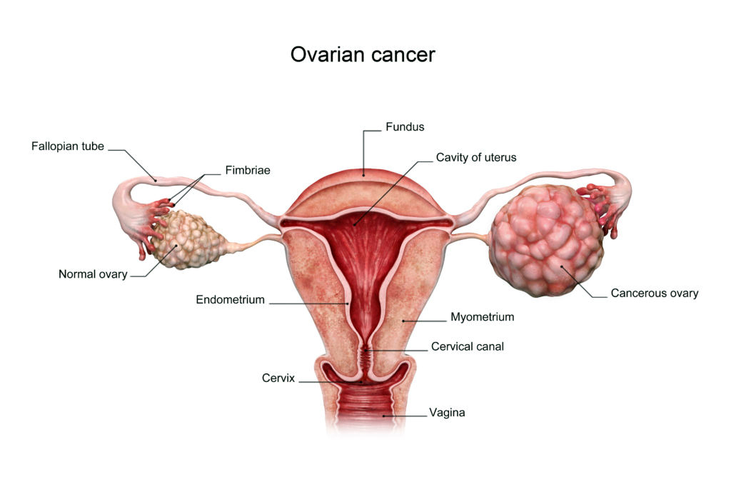 سرطان تخمدان / Ovarian cancer