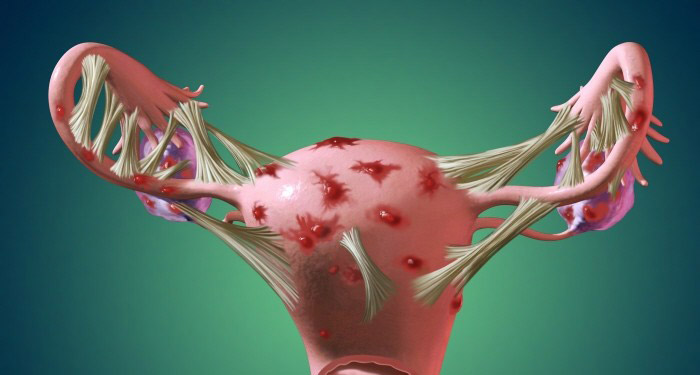 آندومتریوز چیست؟ / Endometriosis