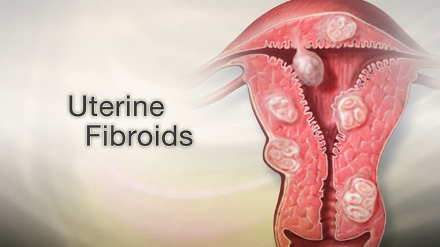 فیبروم رحم / Uterine fibroid