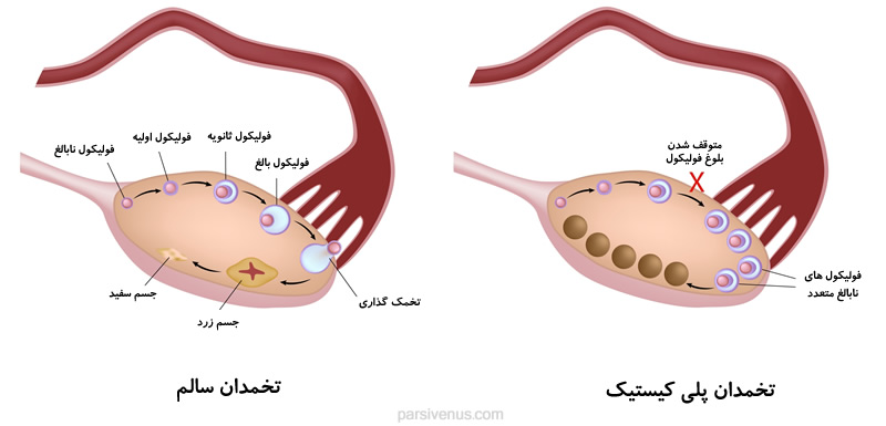 تعریف PCO