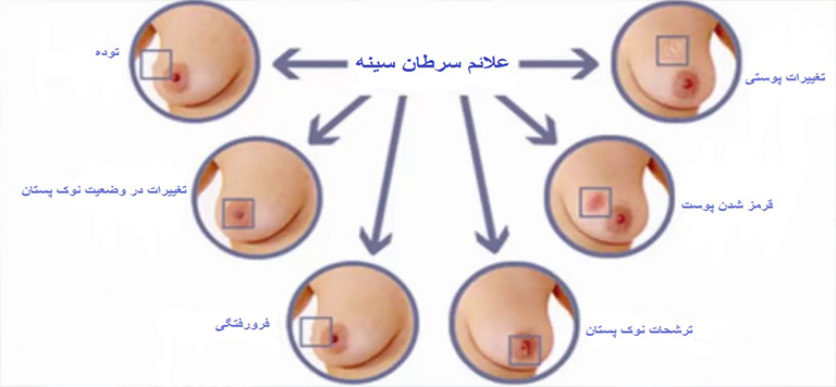 علائم سرطان پستان