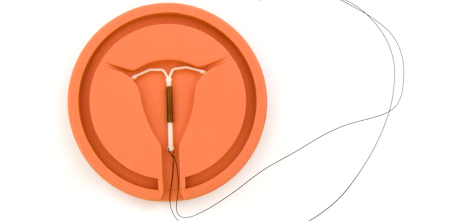 خروج IUD با و بدون نخ