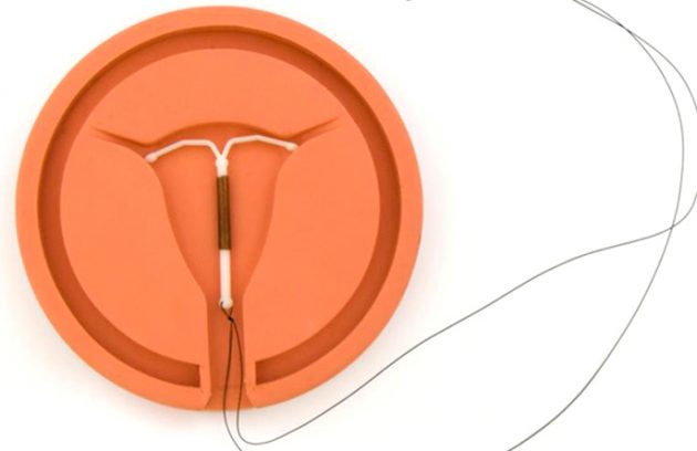 خروج IUD با و بدون نخ