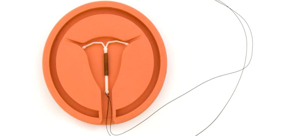 خروج IUD با و بدون نخ