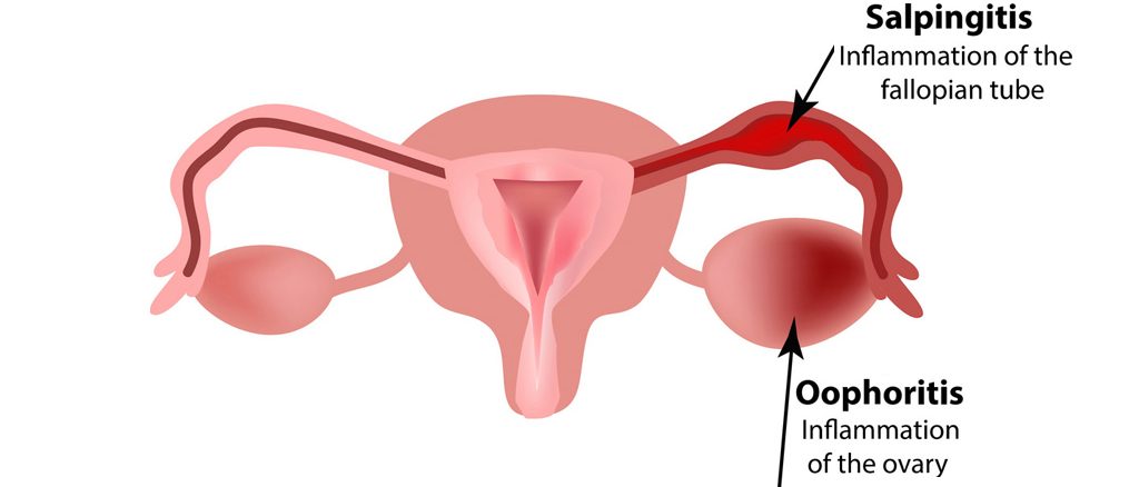 Воспаление яичников у женщин симптомы. Хронический сальпингоофорит. Гонорейный сальпингоофорит. Хронический сальпингит.