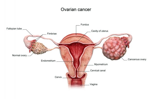 سرطان تخمدان / Ovarian cancer